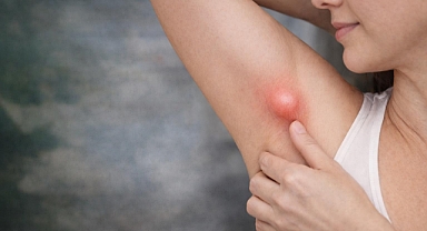 Koltuk Altındaki Şişlik Her Zaman Masum Değil: Ektopik Meme Dokusu Uyarısı